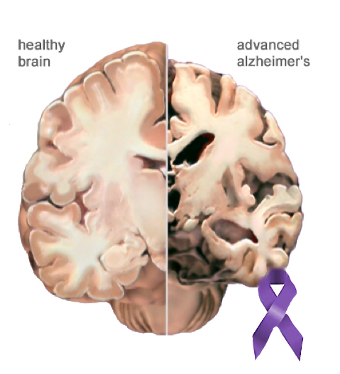 Alzheimers Disease effect on the brain and the AD ribbon