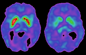 Dopamine levels in the brain from normal levels to Parkinsons affected levels (left to right)