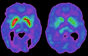 Dopamine levels in the brain from normal levels to Parkinson's affected levels (left to right)