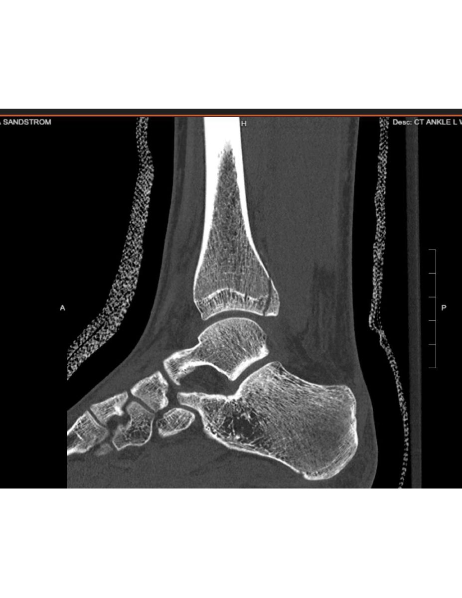 The bone can be seen as visibly fractured. This was taken about two weeks after the break.